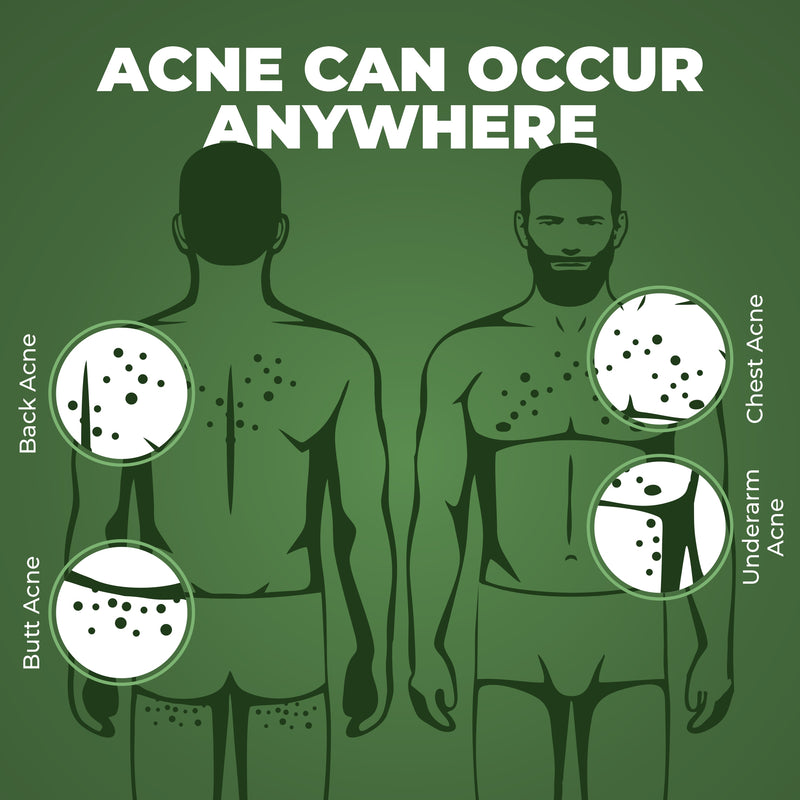 B-Acne Clear Bathing Bar(Pack of 3)