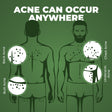 Beardo Body-Acne Clear Bodywash – how to use