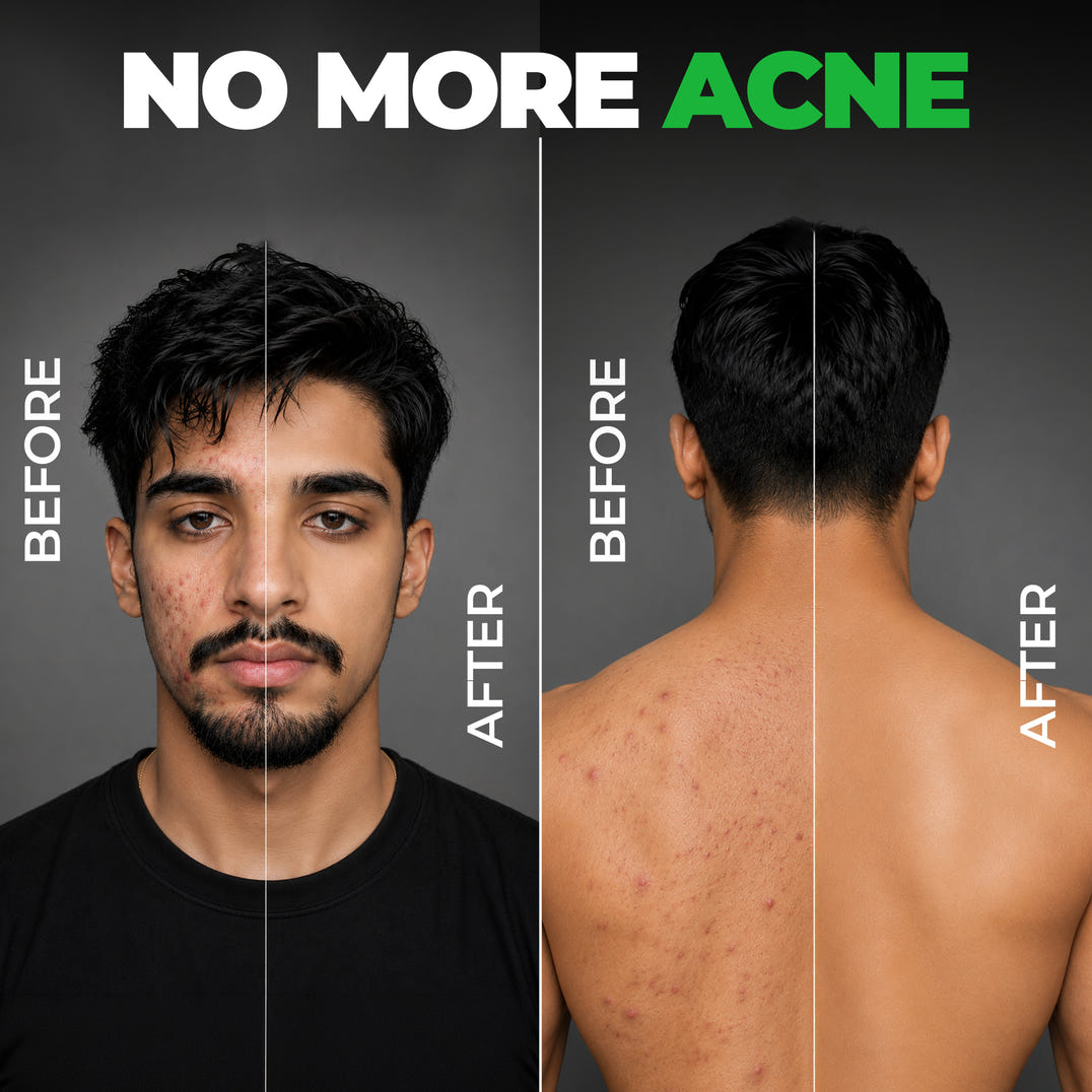 Acne Ka The End Kit