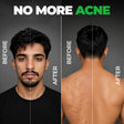 Acne Ka The End Kit